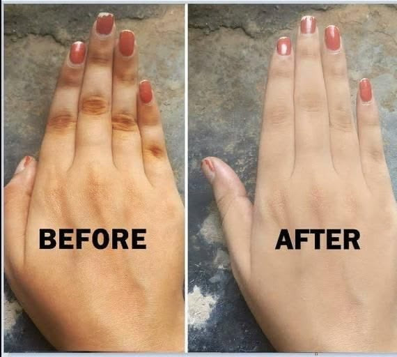 Knuckle Removal Kit